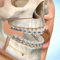 Cirugía ortognática